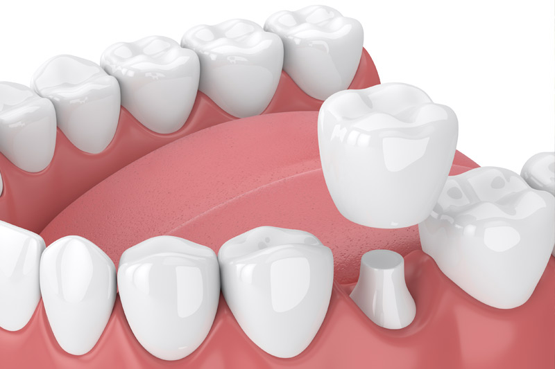 Dental Crowns in Las Vegas