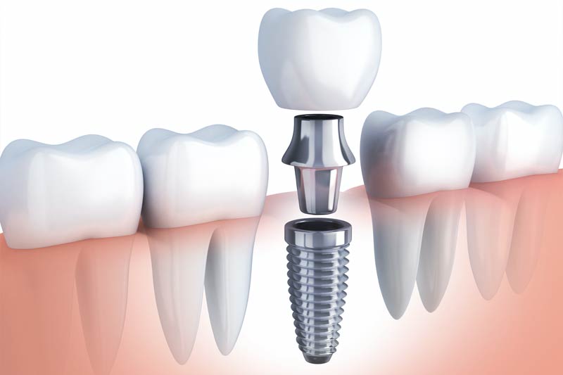 Implants Dentist in Las Vegas